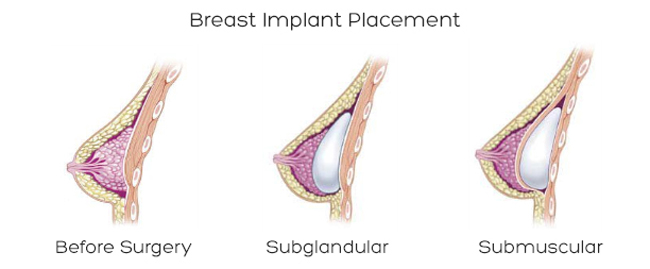 Breast Augmentation by Dr Abdul Khaliq
