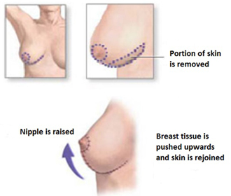 Breast Lift Surgery in Islamabad