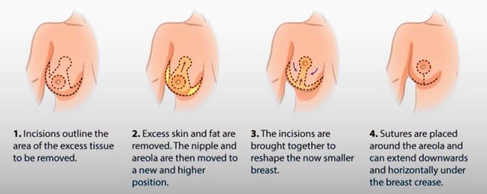 Breast Reduction Surgery in Pakistan