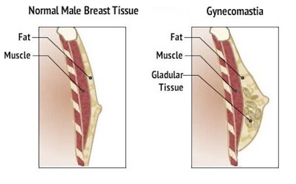 Gynecomastia Surgery by Dr Abdul Khaliq