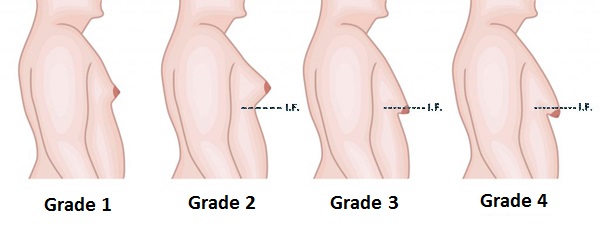 Gynecomastia in Pakistan