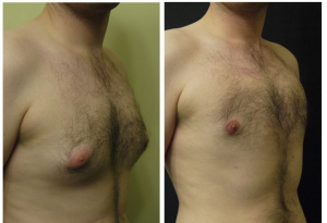 Gynecomastia Surgery Cost in Islamabad