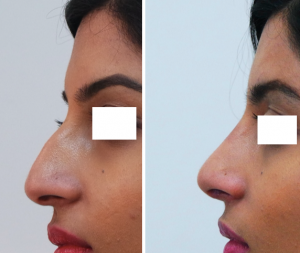 rhinoplasty before and after​