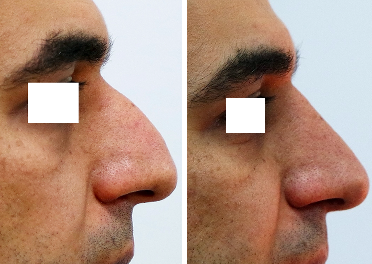 Rhinoplasty in Islamabad