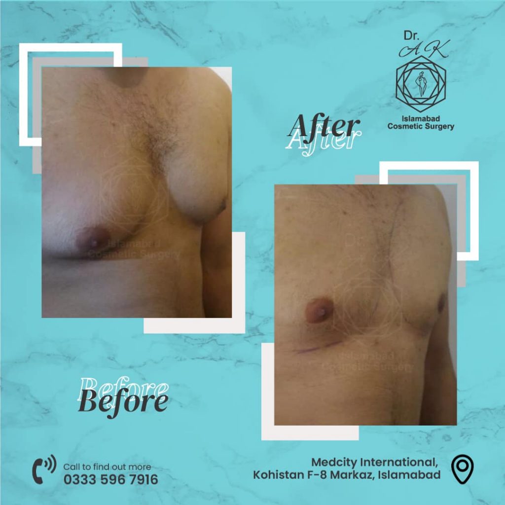 Gynecomastia Islamabad before and after results Islamabad Gynecomastia Islamabad