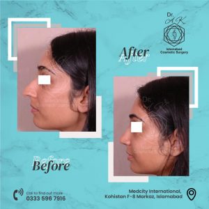 liposuction Islamabad