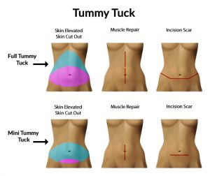 Tummy Tuck in Islamabad