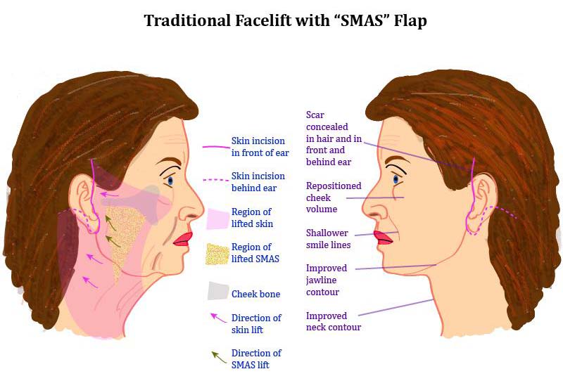 Facelift Final Liposuction in Islamabad