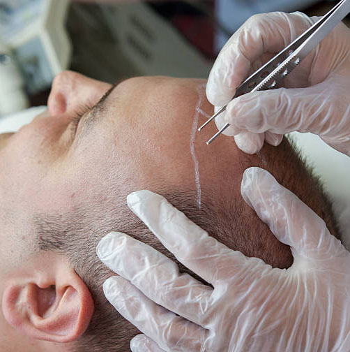 Hair Transplant Hair restoration cosmetic surgery in Islamabad