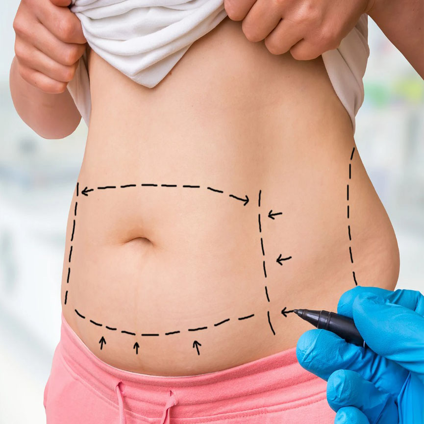 Weight Loss Cosmetic Body contouring cosmetic surgery in Islamabad
