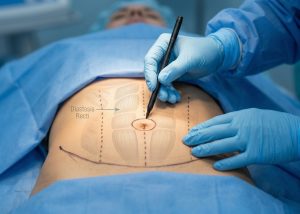 Tummy Tuck in Pakistan