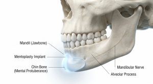 chin augmentation surgery chin augmentation surgery
