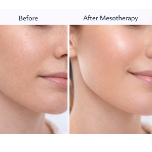 mesotherapy before and after mesotherapy before and after