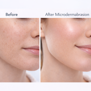 microdermabrasion before and after