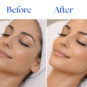 oxygen therapy facial